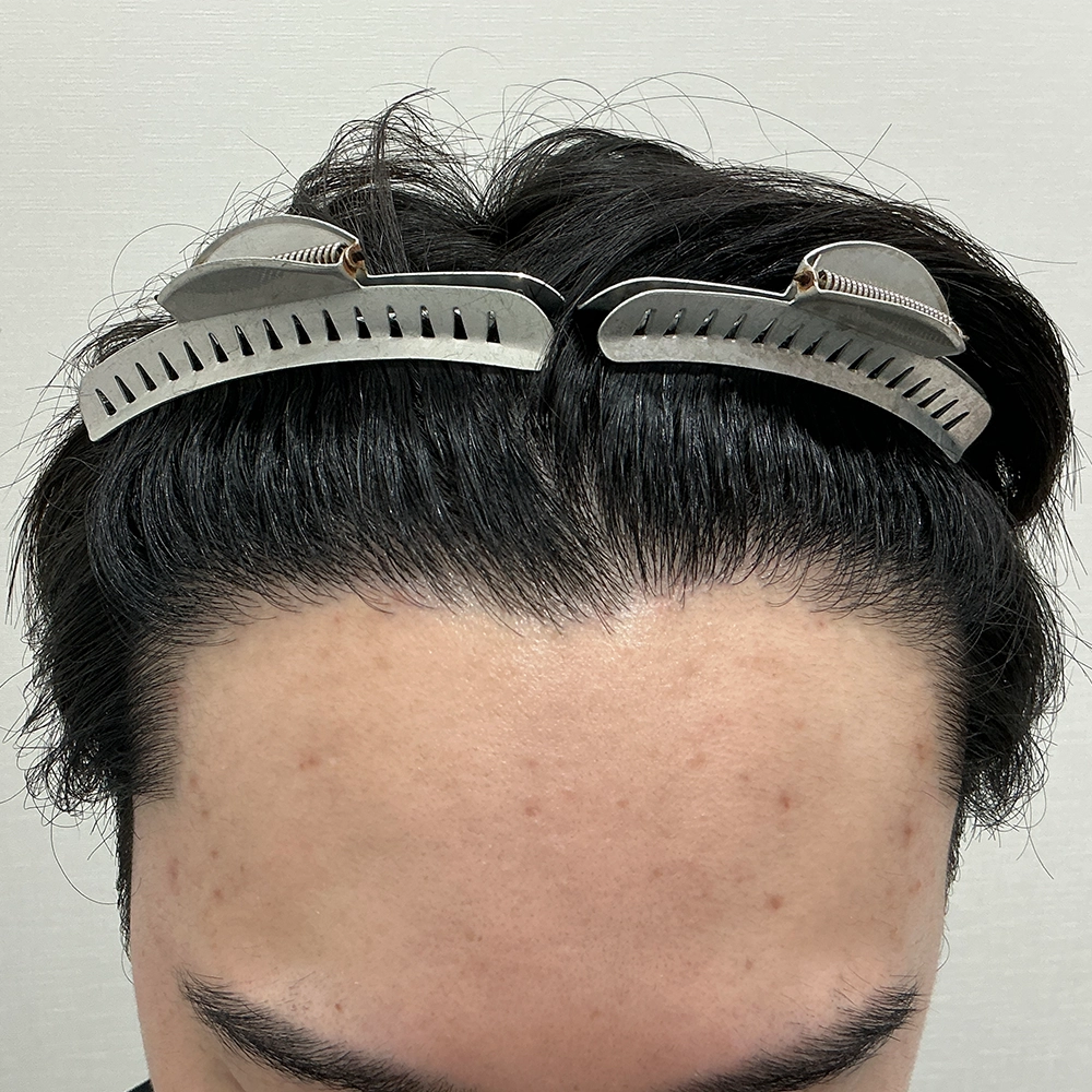 手術後写真