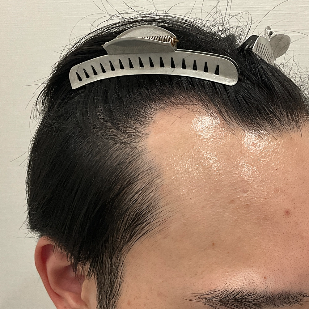 手術前写真