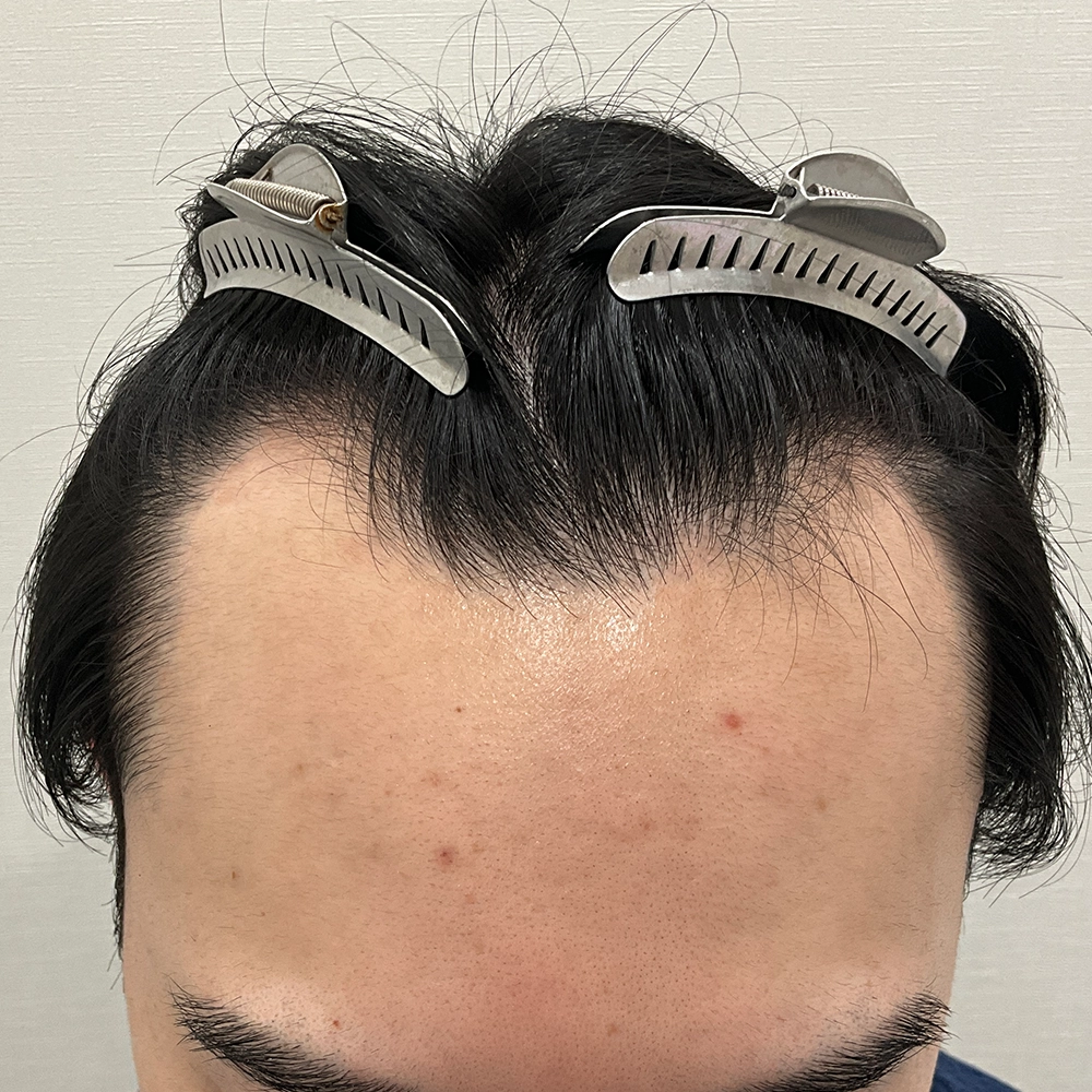 手術前写真