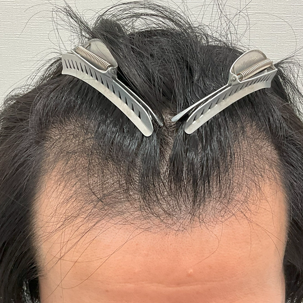 手術前写真